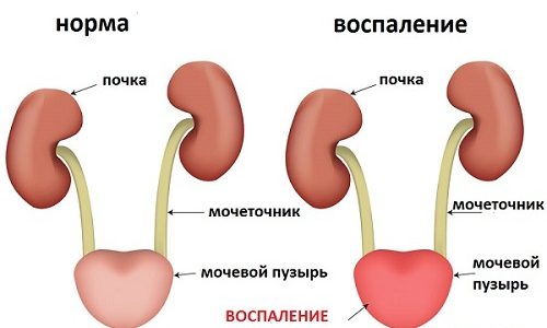 Когда после мочеиспускания можно заметить, что в моче появилась примесь крови, нельзя оставлять это без внимания, ведь такой симптом указывает на острый цистит