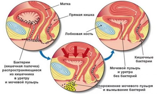 Среди видов цистита врачи выделяют неинфекционный, токсический и аллергический цистит, но практически во всех случаях у пациентов диагностируется болезнь инфекционного характера