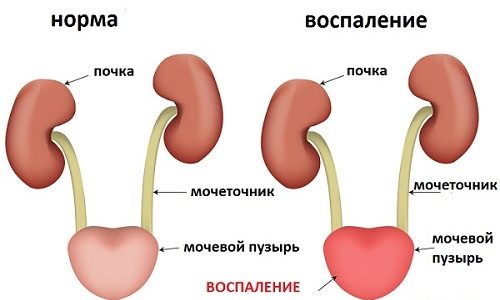 Переохлаждение может вызвать и первичный цистит, и обострение хронического заболевания