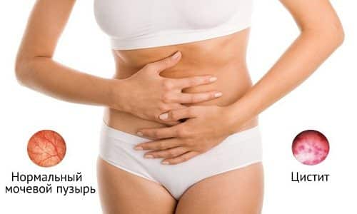 Цистит является инфекционным заболеванием, которое локализуется в мочевом пузыре