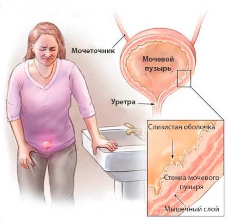 причины возникновения мочевой болезни причины возникновения мочевой болезни