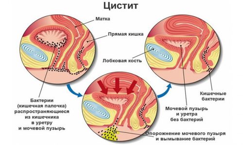 Бактериальный цистит – воспаление стенок мочевого пузыря, которое вызывает условно-патогенная микрофлора, кишечная микрофлора и респираторные бактерии