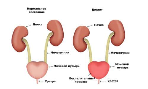 Мочеполовые инфекции, в том числе и цистит, могут быть вызваны самыми различными возбудителями