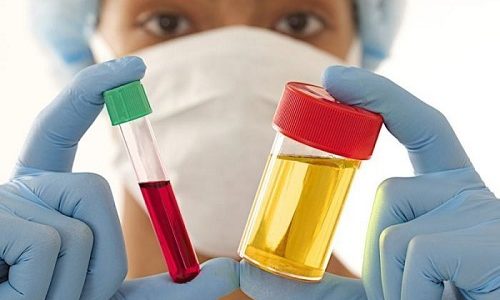 Для подтверждения диагноза специалист назначает несколько лабораторных исследований. Женщины сдают общие анализы крови и мочи (ОАК, ОАМ)