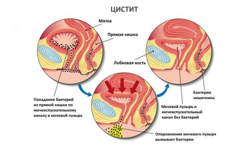 Цистит, особенно в остром периоде, сопровождается повышением проницаемости сосудов и выделением в мочу большого количества эритроцитов, лейкоцитов, белков и других веществ