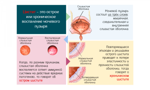 По характеру течения цистит бывает острым и хроническим, первичным (самостоятельное заболевание) и вторичным (проявившимся вследствие других урологических патологий)