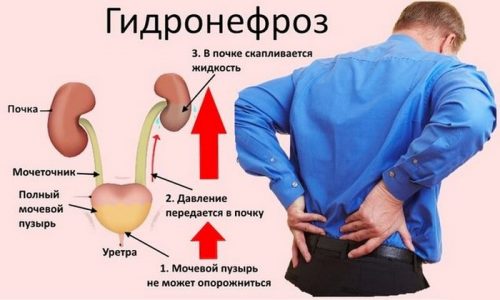 При длительном течении воспалительного процесса может произойти застой мочи в лоханках, что приведет к развитию гидронефроза
