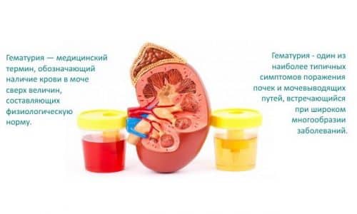 В запущенных случаях цистита после завершения мочеиспускания появляется небольшое количество крови