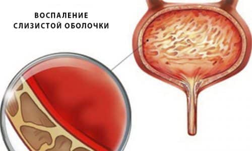 Под термином геморрагический цистит понимается воспаление слизистой оболочки мочевого пузыря с одновременным поражением стенок органа