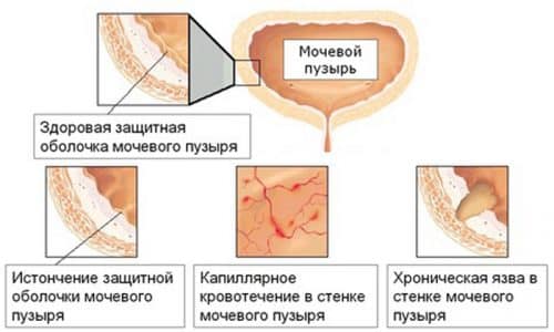 Лучевой цистит с кодом МКБ N30.4 является осложнением лучевой терапии, которая проводится лицам с онкологическими заболеваниями органов мочеполовой системы