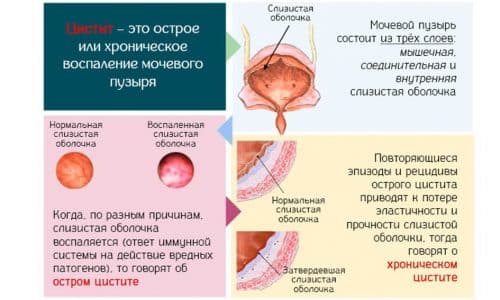 По характеру течения различают острую и хроническую формы цистита у детей