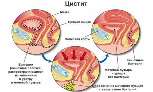 Симптомы, возникающие при инфицировании мочевого пузыря различными патогенными возбудителями, зависят от их типа и заболевания, вызвавшего патологию