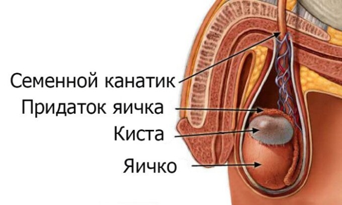 Из-за кисты яичка происходит сдавливание мочевого пузыря и возникновение дизурии