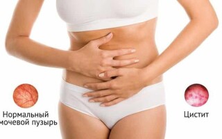 Как вылечить цистит