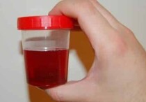 Причины появления темной мочи