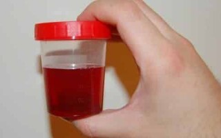 Причины появления темной мочи