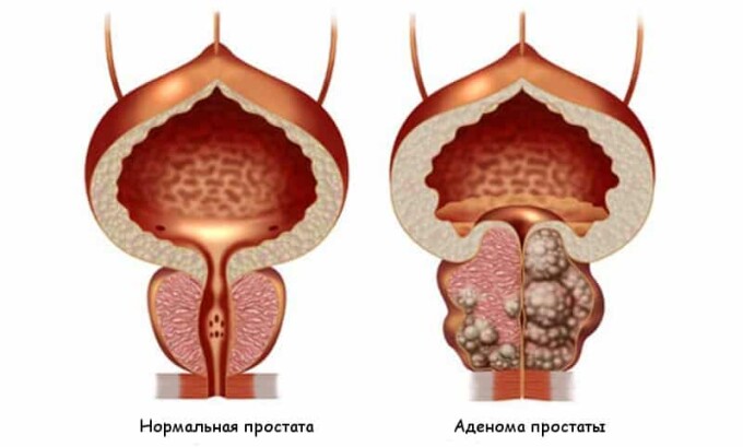 Для мужчин цистит опасен распространением патогенных микробов в предстательную железу и риском возникновения аденомы простаты