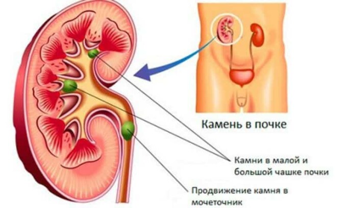 Основой для развития этого патологического состояния являются различные распространенные в урологии заболевания, которые сопровождаются застоем мочи и обструкцией путей