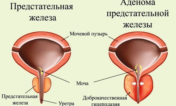 Частое мочеиспускание появляется при развитии аденомы простаты