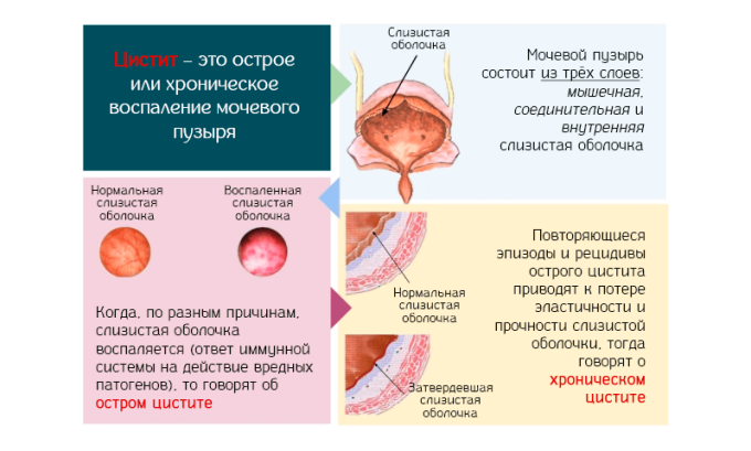 Важную роль при образовании темно-коричневой окраски играет цистит. Примесь крови становится причиной возникновения характерного оттенка