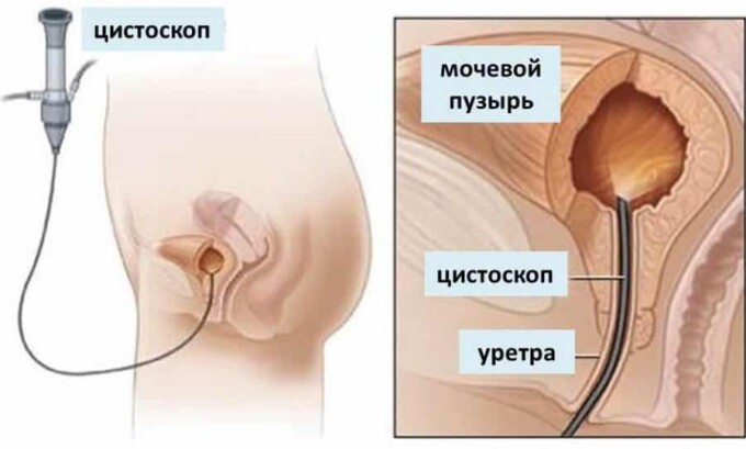 Если признаки цистита появились не впервые, необходимо сделать цистоскопию у уролога. Это особенно важно при хроническом течении заболевания, т. к. врач сможет оценить степень повреждения стенок мочевого пузыря и определить вид цистита