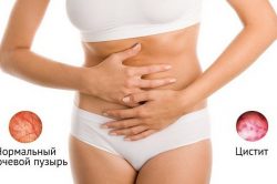 Как вылечить цистит