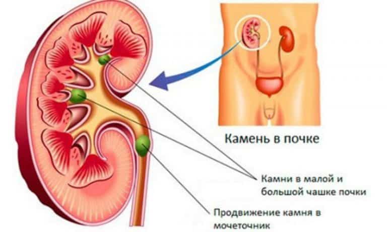 Основой для развития этого патологического состояния являются различные распространенные в урологии заболевания, которые сопровождаются застоем мочи и обструкцией путей
